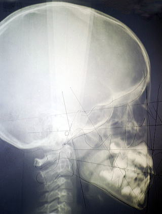 頭部エックス線規格写真