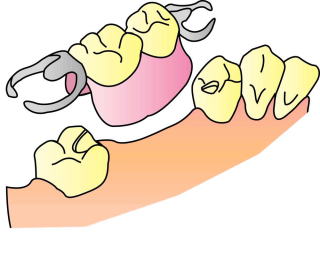義歯概念図