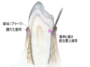 歯肉炎歯肉の断面像