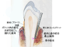 重度歯周病の断面像