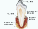 末期歯周病の断面像