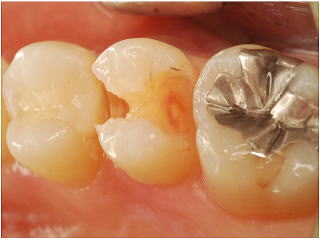 ドーナツ状の虫歯の進行