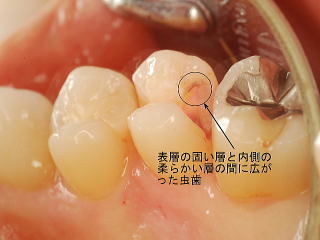 エナメル質下の虫歯