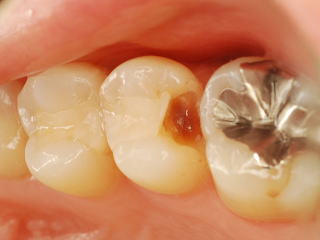 治療前の虫歯