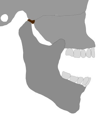 関節円板前方転位した下顎の開口時