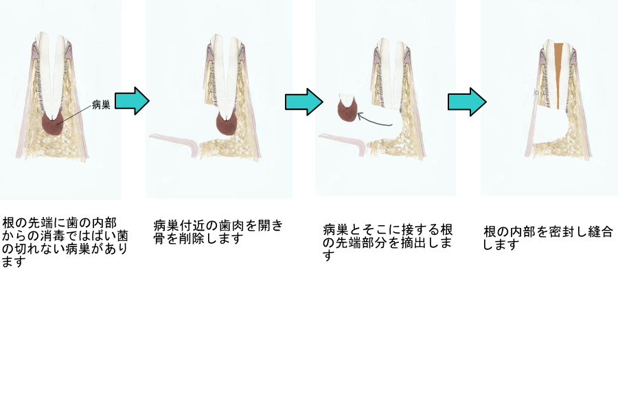 歯根端切除術説明図